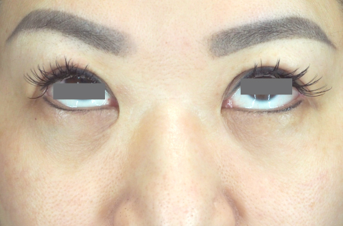 目の下の脂肪取り（40代｜女性）3ヶ月後