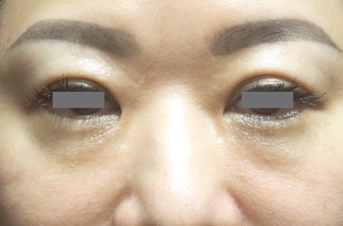 目の下の脂肪取り（40代｜女性）