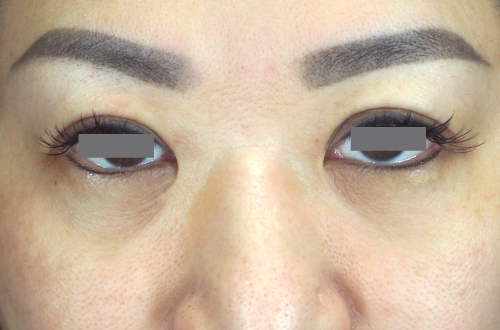 目の下の脂肪取り（40代｜女性）3ヶ月後