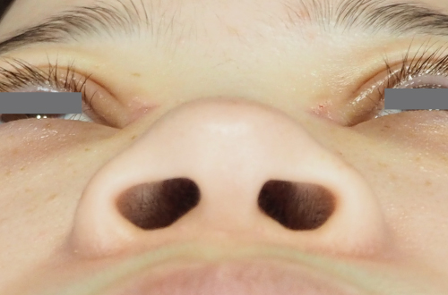 整鼻術（20代｜女性）