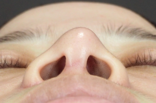 整鼻術（20代｜女性）6ヶ月後