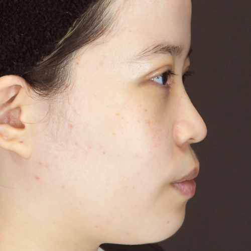 整鼻術（20代｜女性）