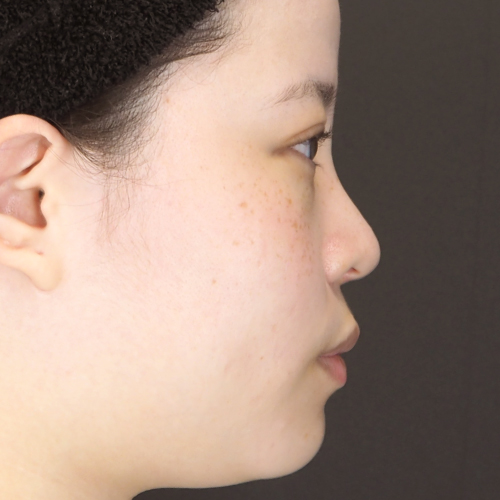 整鼻術（20代｜女性）6ヶ月後