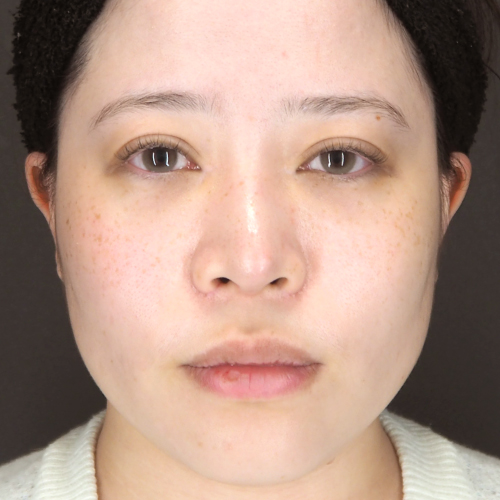 整鼻術（20代｜女性）6ヶ月後