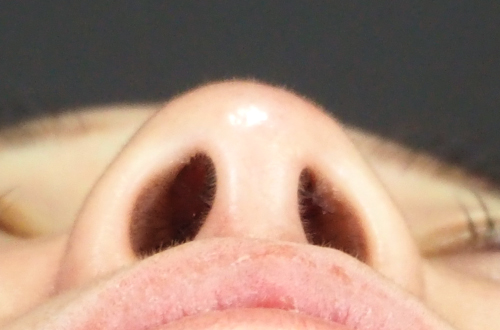 整鼻術（20代｜女性）