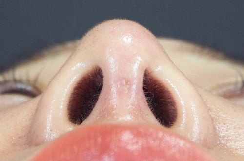 整鼻術（20代｜女性）6ヶ月後