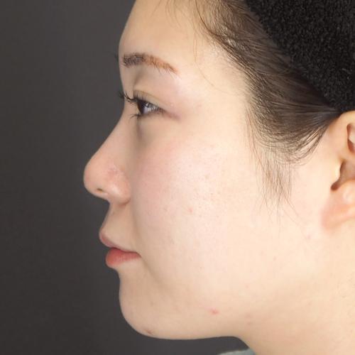 整鼻術（20代｜女性）
