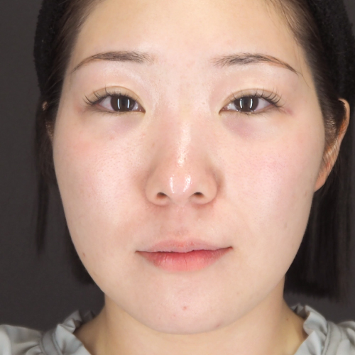 整鼻術（20代｜女性）