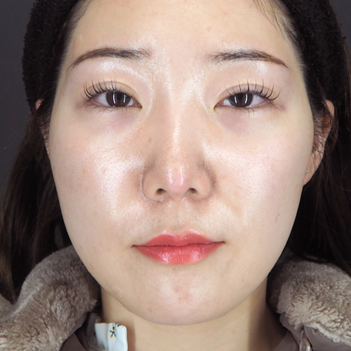 整鼻術（20代｜女性）6ヶ月後