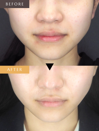 エラのボトックス注射