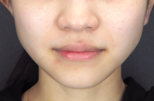 エラのボトックス注射(10代|女性)