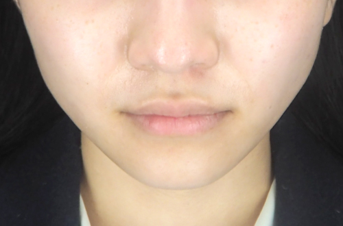 エラのボトックス注射(10代|女性)1ヶ月後