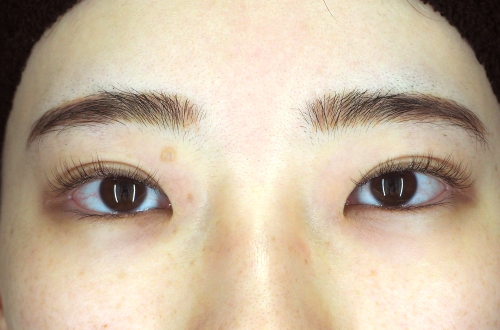 目頭切開法（20代｜女性）