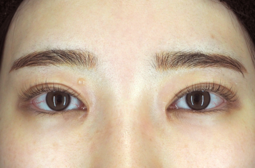 目頭切開法（20代｜女性）3ヶ月後