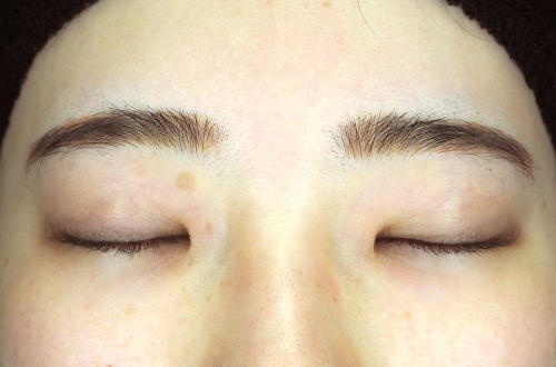 目頭切開法（20代｜女性）