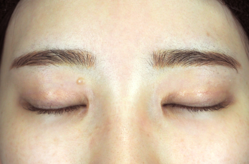 目頭切開法（20代｜女性）3ヶ月後