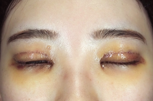 1週間後（抜糸後）