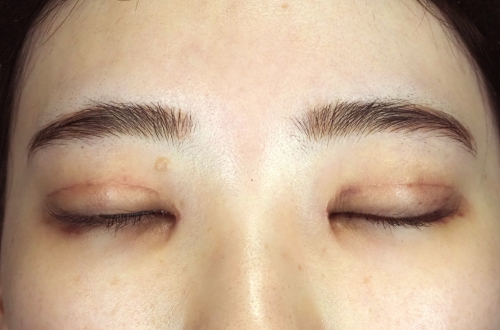 10日後（抜糸後）