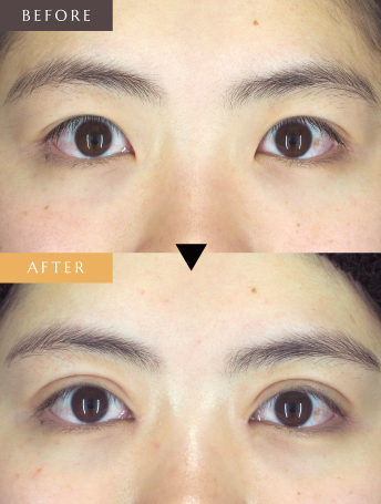 二重切開+目頭切開