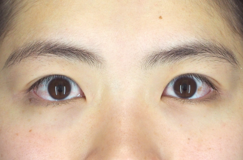 二重切開法(20代|女性)