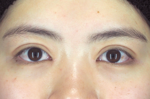 二重切開法(20代|女性)3ヶ月後