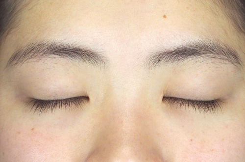 二重切開法(20代|女性)