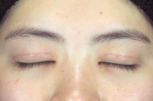 二重切開法(20代|女性)3ヶ月後