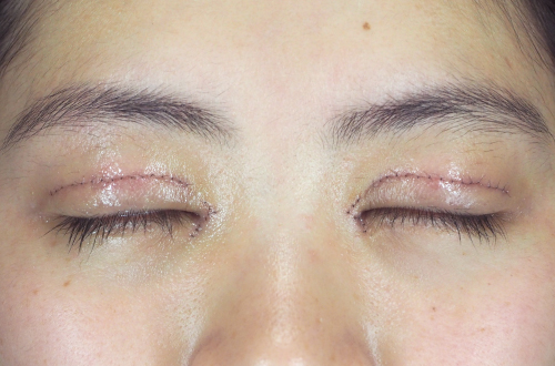 1週間後（抜糸前）