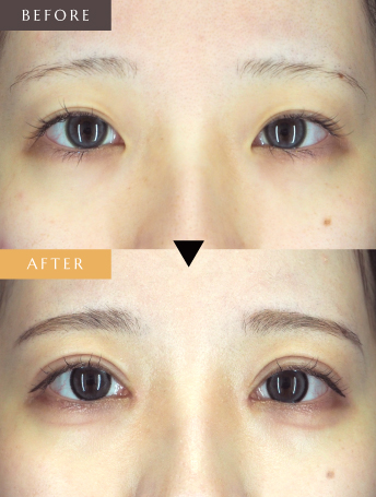 二重切開＋目頭切開