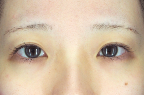 二重切開法(20代|女性)