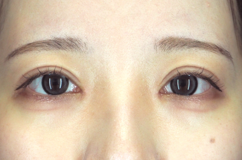 二重切開法(20代|女性)3ヶ月後