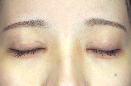 二重切開法(20代|女性)3ヶ月後