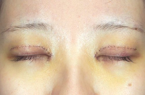 1週間後（抜糸前）