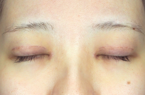 10日後（抜糸後）