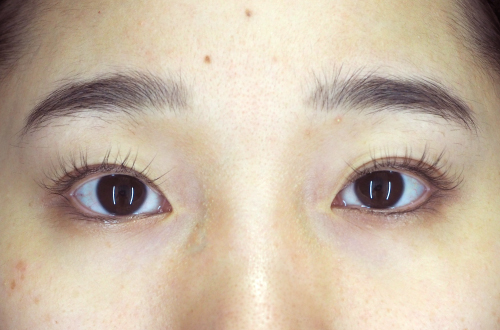 二重切開法(30代|女性)