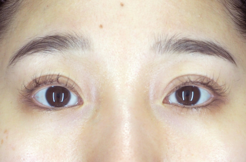 二重切開法(30代|女性)3ヶ月後