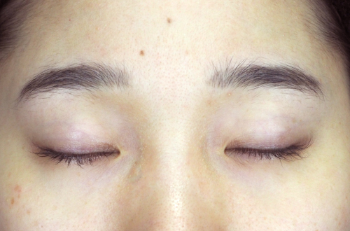 二重切開法(30代|女性)