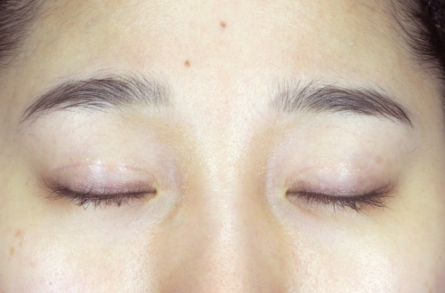 二重切開法(30代|女性)3ヶ月後