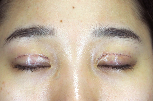 1週間後（抜糸前）