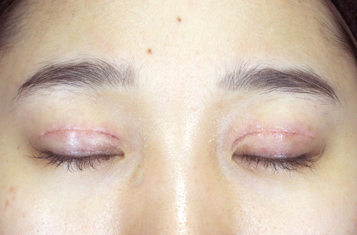 1週間後（抜糸後）