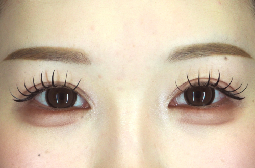 二重切開法(20代|女性)3ヶ月後