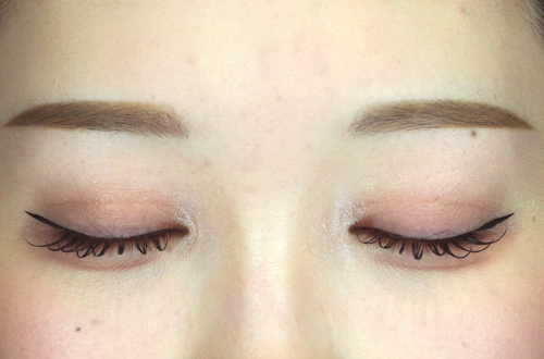 二重切開法(20代|女性)3ヶ月後