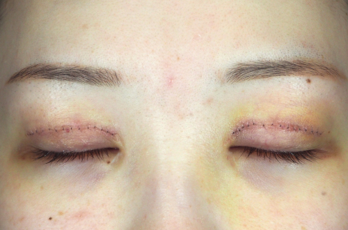 1週間後（抜糸前）