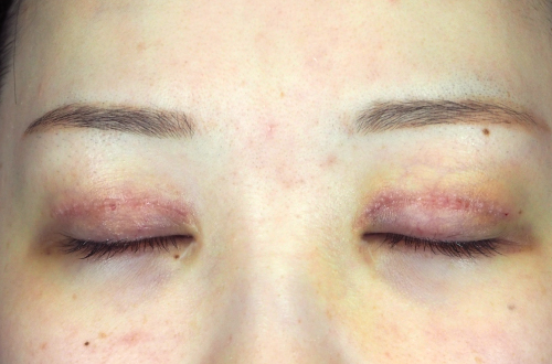 1週間後（抜糸後）