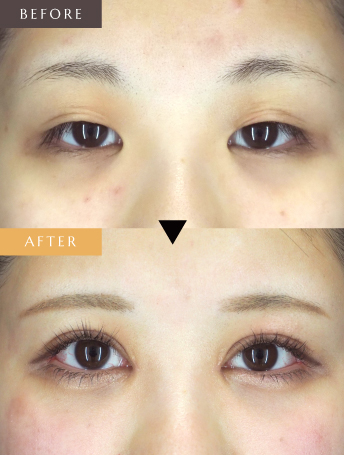 眼瞼下垂+目頭切開+目尻切開