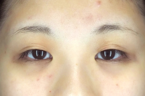 眼瞼下垂(20代|女性)