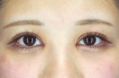 眼瞼下垂(20代|女性)3ヶ月後