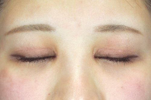 眼瞼下垂(20代|女性)3ヶ月後