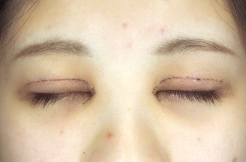 1週間後（抜糸前）