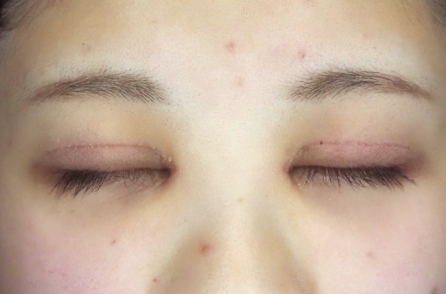 1週間後（抜糸後）